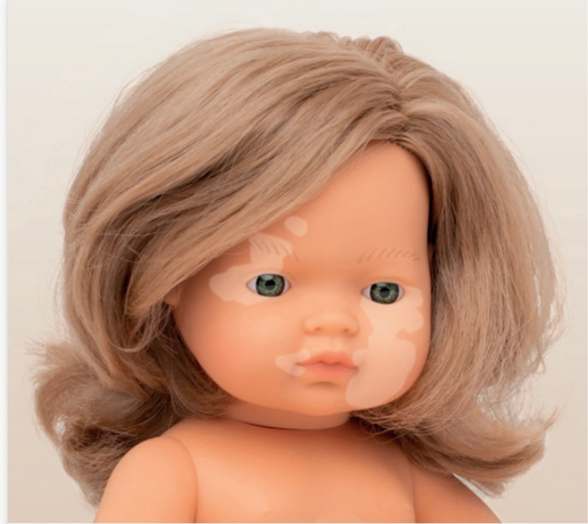 Miniland girl with Vitiligo